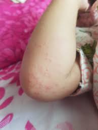 Ia adalah salah satu penyakit yang sangat mudah berjangkit. Petua Merawat Hfmd Dan Campak Keladi Tiny Na Sweet