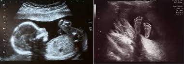 We provide free ultrasound and an accurate picture of your pregnancy. Pregnancy Obstetric Focus Ultrasound