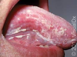 Image result for Oral thrush roof of mouth
