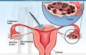 Ovari normal vs cyst ovari. Ubat Penawar Rawatan Alternatif Kecutkan Cyst Secara Semulajadi Tanpa Pembedahan Pengedar Shaklee Stokis Shaklee Vivix Shaklee