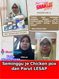 Cara hilangkan parut chicken pox dewasa : Hilangkan Parut Chicken Pox Yang Hodoh Dengan Cepat