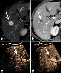 It is performed for diagnostic and research purposes, and to determine the best method of treatment. Colorectal Liver Metastases Radiopathological Correlation Insights Into Imaging Full Text