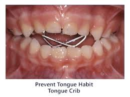In tongue thrust, the tongue pushes against the front teeth or through them and air escapes from the mouth while swallowing. Early Orthodontics Dr Brock Rondeau Associates