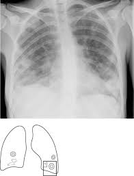 Image result for Lung Abscess