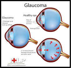 Glaucoma is a group of eye diseases that can cause vision loss and blindness by damaging the nerve in the back of your eye called the optic nerve. Pin On Eye