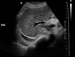 30 effusions are also sometimes referred to as sonographically complex, which is an echogenic effusion with or without septations. Pleural Effusion Radiology Reference Article Radiopaedia Org