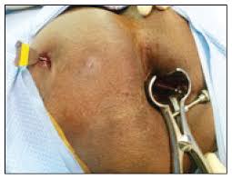 Perianal fistulization is an uncommon but important condition of the gastrointestinal tract that causes substantial morbidity. Evaluation Of The Cutting Seton As A Method Of Treatment For Perianal Fistula Annals Of Saudi Medicine