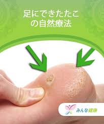 足にできたたこの自然療法 みんな健康 自然療法 治す 健康