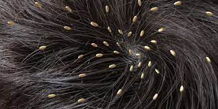 Maybe you would like to learn more about one of these? 9 Cara Menghilangkan Kutu Rambut Dan Telurnya Secara Alami Dan Permanen Merdeka Com