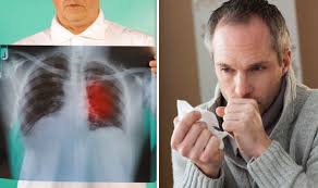 This growth can spread beyond the lung by the process of metastasis into nearby tissue or other parts of the body. World Cancer Day These Signs Could Help You Spot Lung Cancer Early Express Co Uk