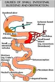 A Pengertian Ileus Paralitik Adalah Istilah Gawat Abdomen Atau Gawat Perut Menggambarkan Keadaan Kl Small Bowel Obstruction Bowel Obstruction Subdural Hematoma