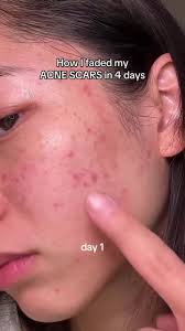 Avocado Oil for Skin Before and After