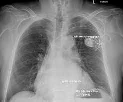 Entsprechend ihrer hohen dichte sind knochen auf einer röntgenaufnahme hell. Https Www Uksh De Uksh Media Dateien Kliniken Institute L C3 Bcbeck Campuszentrum Med2 Hl Newsletter 22 Newsletter Universit C3 A4res Herzzentrum L C3 Bcbeck P 458238 Pdf