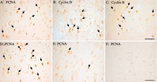 Image result for alzheimer 1981 2021