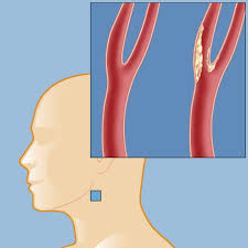 Your carotid arteries are two large blood vessels in your neck. Carotid Occlusive Disease Weill Cornell Brain And Spine Center