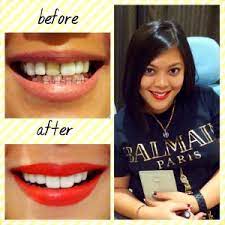 We did not find results for: Senyum Putih Cemerlang Dengan Veneer Gigi Audy Dental