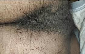 Image result for pubic lice symptoms
