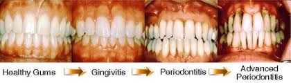 Image result for Periodontitis