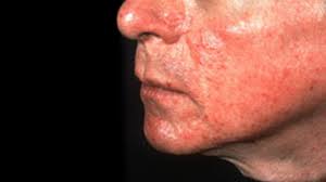 Browse our listings to find jobs in germany for expats, including jobs for english speakers or those in your native language. Rosacea Types Causes And Remedies