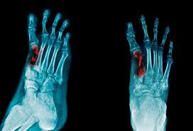 Athletes foot itches and burns, and over time it will get more painful. Osteomyelitis Treatment Symptoms Definition Causes