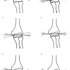 Pdf Variation In The Position And Orientation Of The Elbow Flexion Axis