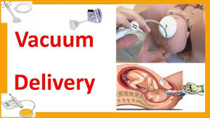 Image result for Vacuum Caput