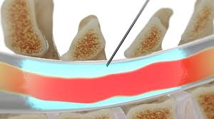 Image result for Lower Cervical Intramuscular Injection