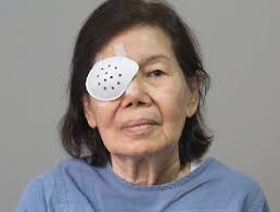 NEW APPROACHES TO ENDOTHELIAL TRANSPLANTS