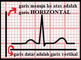 Jika kalibrasinya 20 mm maka gambaran vertical (menuju keatas atau kebawah) pada setiap satu kotak kecil adalah 2 milivolt. Mengenal Kalibrasi Ekg Untuk Ketepatan Interpretasi Penilaian Ekg Jantung Area