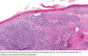 Merkel cell carcinoma may be detected during a physical exam by your doctor or dermatologist. Pathology Outlines Merkel Cell Carcinoma
