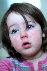 Image result for Scarlet Fever
