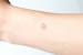 Keloid Scar On Face