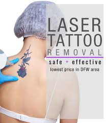 Jun 17, 2021 · you don't walk into a tattoo studio planning to wipe it off later. Laser Tattoo Removal Safe And Effective Dallas Fort Worth Texas