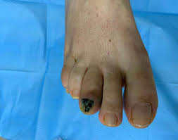 Image result for toe black diabetes