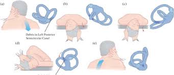 Studies show that the epley maneuver is effective for relieving dizziness caused by benign paroxysmal. Modified Epley Maneuver For Treating Left Sided Bppv Reproduced From Download Scientific Diagram