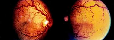 Image result for Hyperviscosity Syndrome