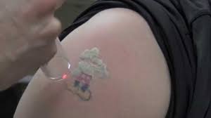 Las vegas laser tattoo removal by skin city laser. Laser Tattoo Removal At Las Vegas Dermatology Get Your Fresh Canvas Today Youtube