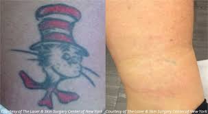 New york skin & vein is upstate new york's leading provider of laser tattoo removal. Tattoo Removal Service New York Nyc Laser Skin Center