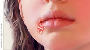 Image result for Impetigo