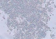 Urine Crystals Flashcards Cram Com