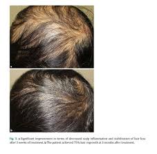 Unfortunately, hair loss is common with scalp psoriasis, per the npf—but it's more about damage to the hair shaft and follicles from excessive itching, rubbing, and combing; Psoriatic Alopecia In A Patient With Systemic Lupus Erythematosus Document Gale Academic Onefile