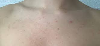 Ausschlag Brust Pickel Gesundheit Und Medizin Haut Aussehen