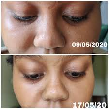 Includes dose adjustments, warnings and precautions. My Fungal Acne Safe Routine Sharon Malonza