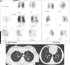 Image result for Ventilation Perfusion Scan