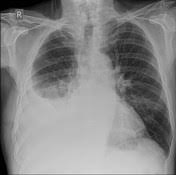 The term bilateral pleural effusion refers to the dysfunction of the lubricating fluid found between both lungs and the chest wall. Pleural Effusion Radiology Reference Article Radiopaedia Org