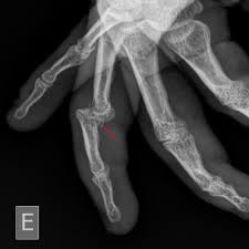 Image result for Lateral PIP Dislocation