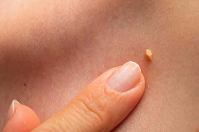 Wart Removal - Vermont Urgent Care