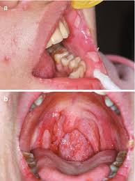 Image result for Secondary Syphilis