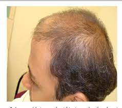 Hair loss istockphoto radiation damages hair follicles. Pdf Hair Loss Due To Electromagnetic Radiation From Overuse Of Cell Phone Semantic Scholar