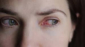 Image result for Allergic Conjunctivitis